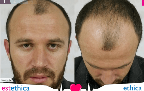 زراعة شعر الرأس